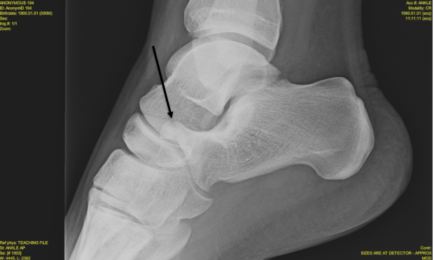 anterior calcaneus fracture