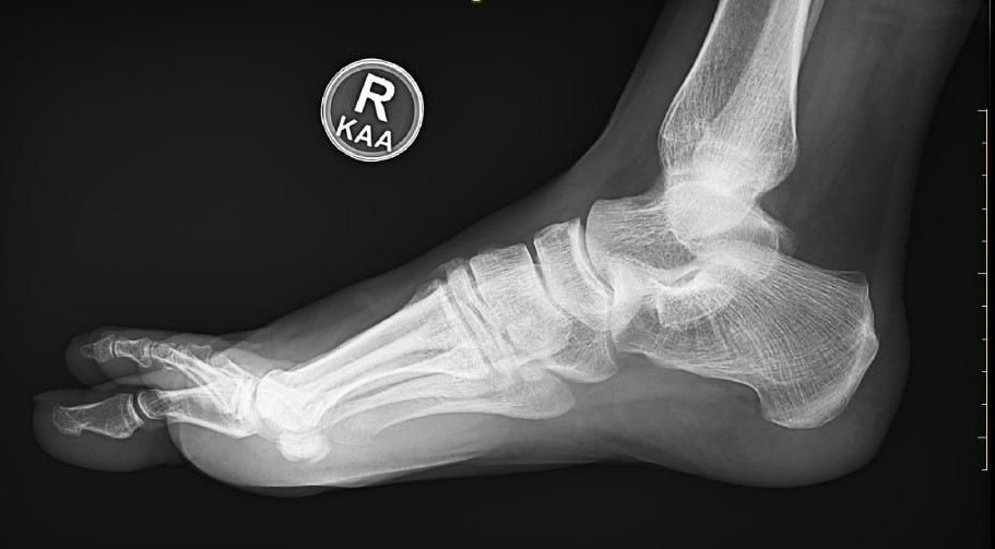 A Runner with a History of Foot Pain - Journal of Urgent Care Medicine