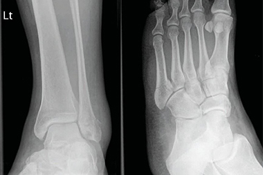 A 48-Year-Old Female Who ‘Rolled’ Her Ankle
