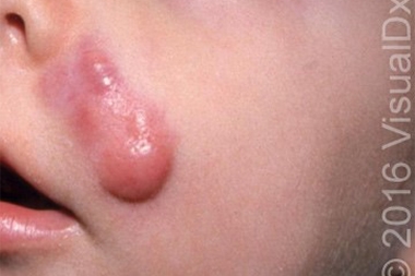 A 2-Year-Old with a Nodule on His Face—and Other Concerning Symptoms