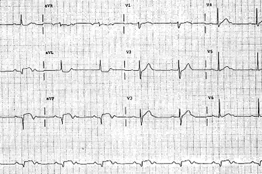 A 55-Year-Old Man with 3 Hours of Epigastric Pain