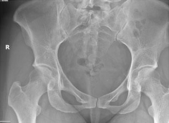 A 47-Year-Old Woman with Hip Pain After Exercise
