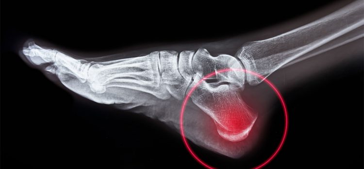 Top 5 Common Causes—and Controversial Conducts—of Heel Pain in Urgent Care
