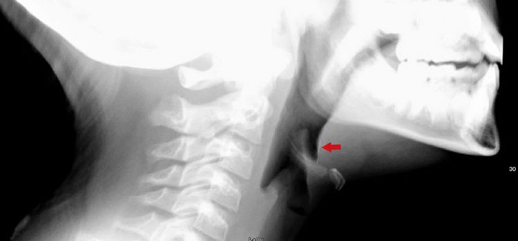 A 9-Year-Old Girl with Sudden-Onset Sore Throat After a Meal