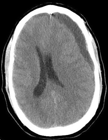 An Unusual Etiology of Chronic Subdural Hematoma: Case Report and ...