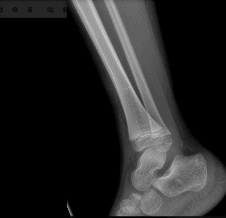 A 6-Year-Old Boy with Leg Pain After a Hard Impact - Journal of Urgent ...