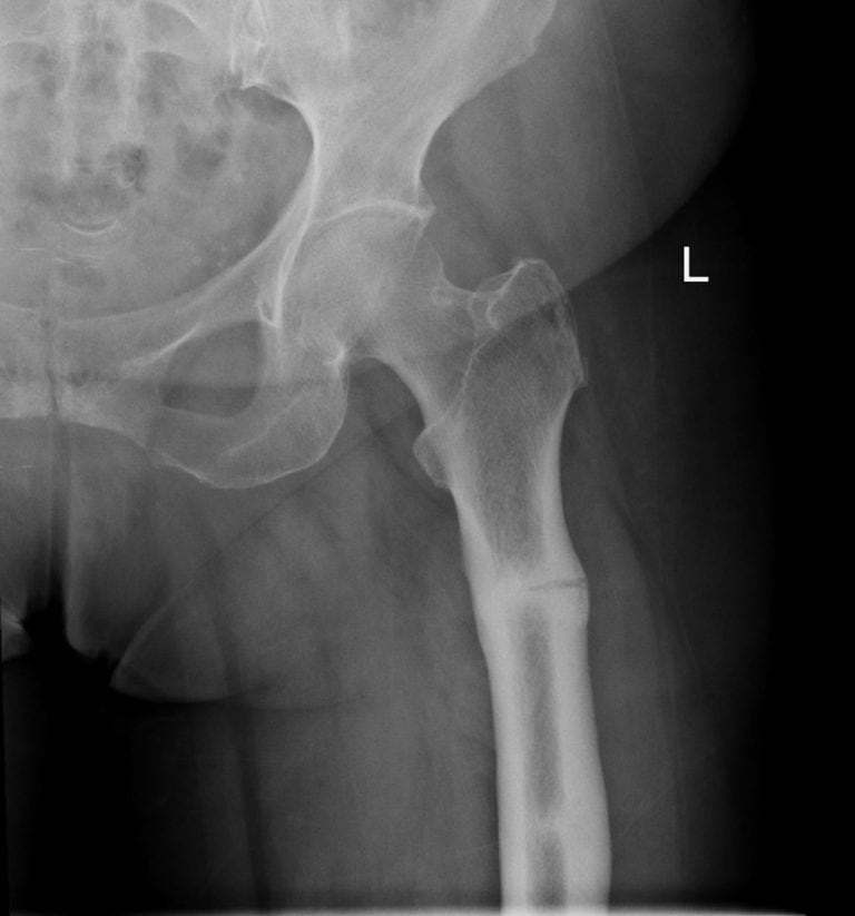 A 65-Year-Old Female with Hip Pain After a Stumble - Journal of Urgent ...