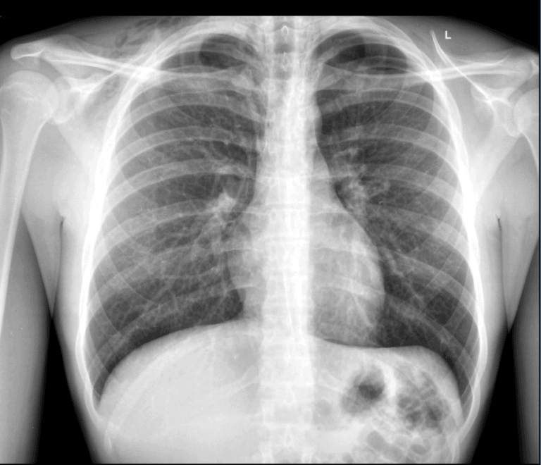 An 18-Year-Old Male with Shortness of Breath and ‘Tightness’ in His ...