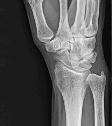 A 53-Year-Old Male with Wrist Pain After a Fall - Journal of Urgent ...