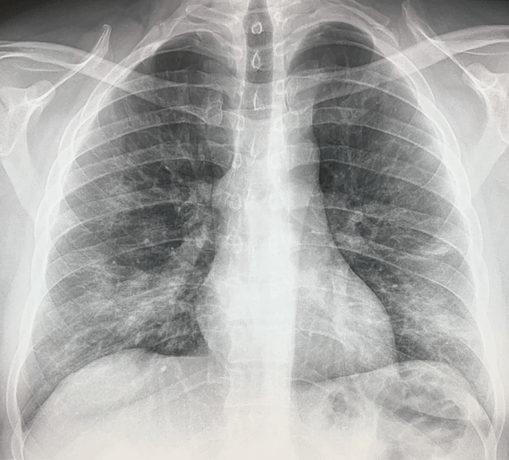 Chest X-Ray Findings in 636 Ambulatory Patients with COVID-19 ...