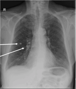 A 28-Year-Old Male with a Persistent Dry Cough - Page 2 of 2 - Journal ...