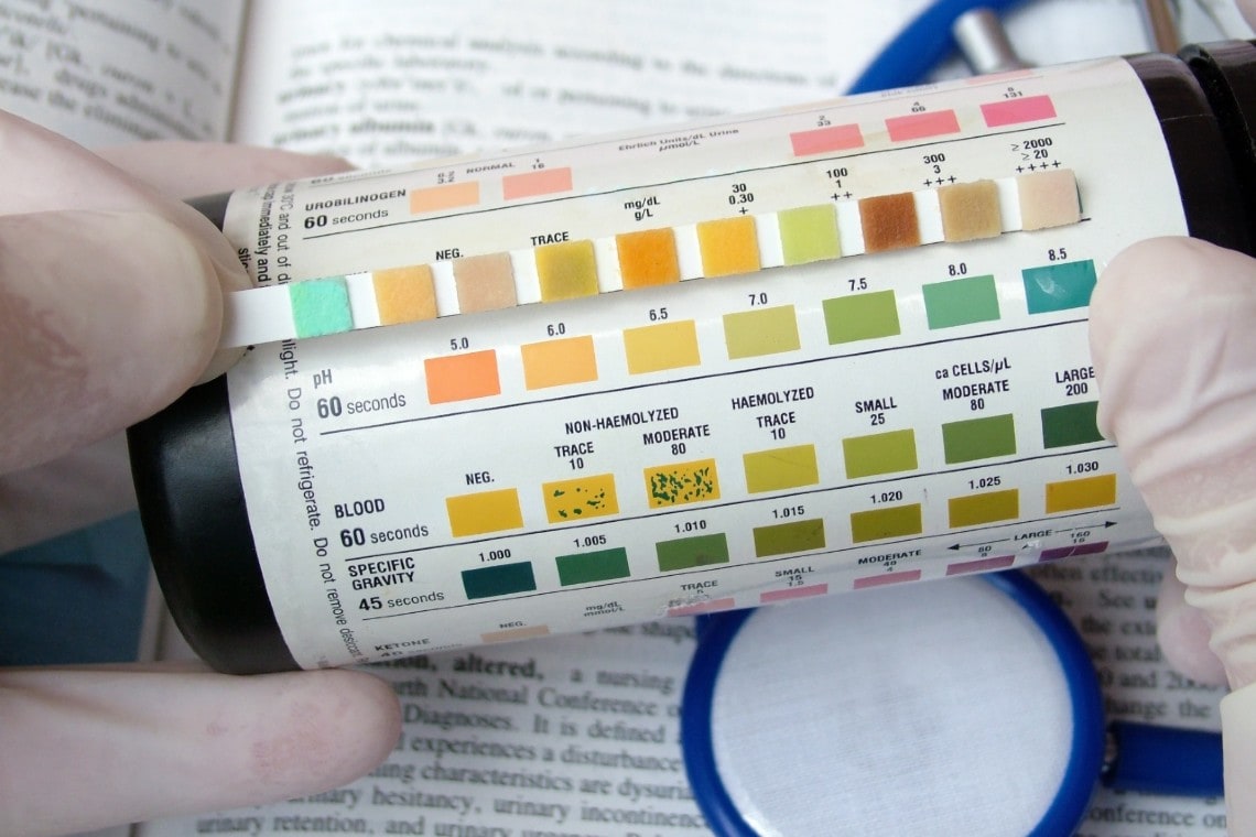 Urinalysis A Simple Test With Complicated Interpretation Journal Of 