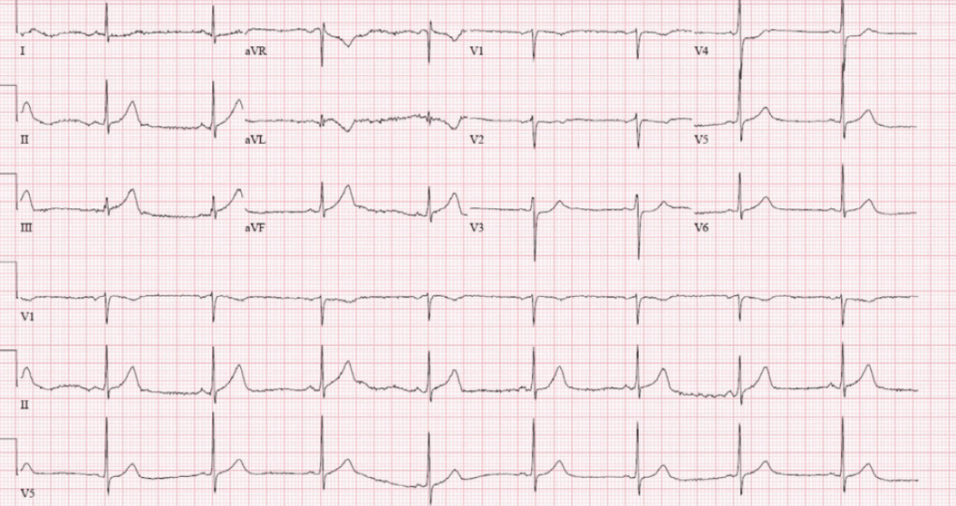 A 67-Year-Old Male with Classic Signs of Myocardial Infarction ...