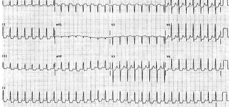 Update: The Lancet Has Withdrawn an Article Associating Hydroxychloroquine with Ventricular Arrhythmia