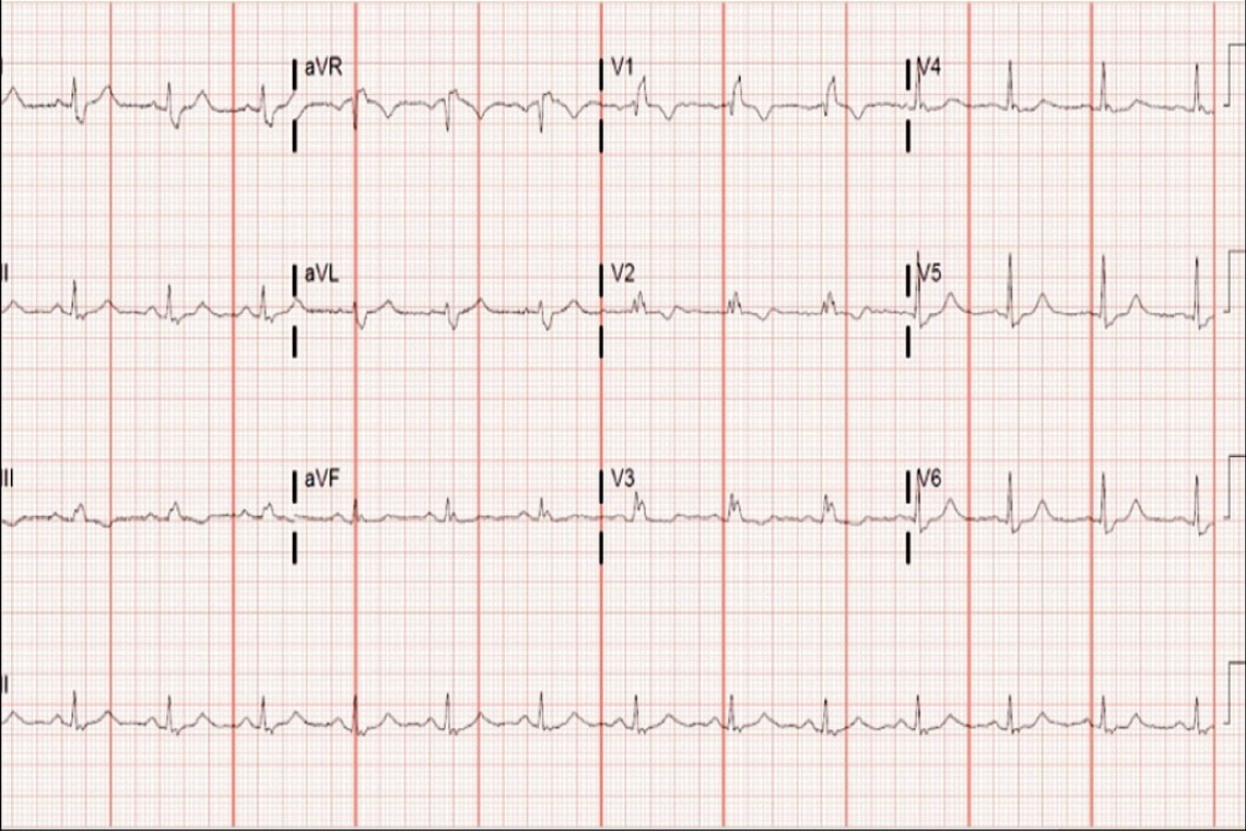 A 42 Year Old Male With An Abnormal ECG Page 2 Of 2 Journal Of 