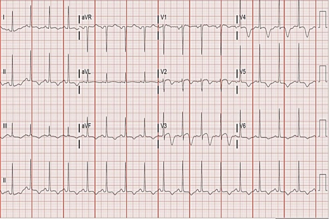 A 60-Year-Old Woman with a 4-Day History of Intermittent Exertional ...