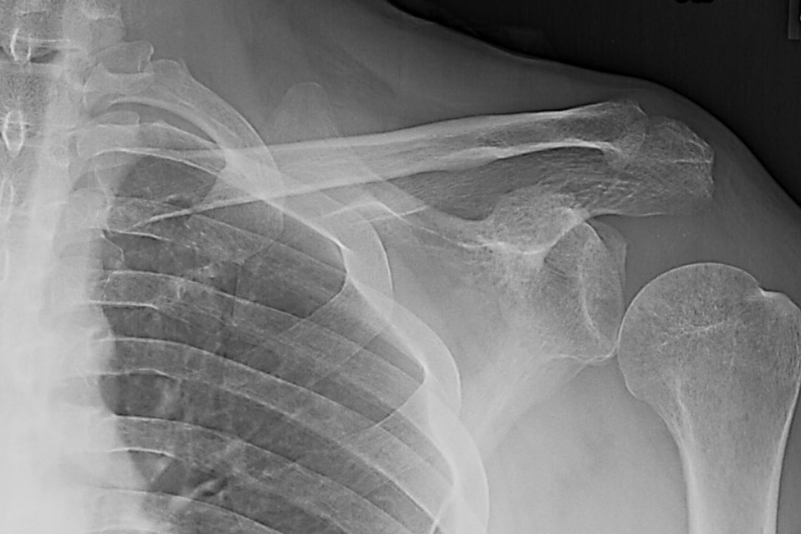 a-35-year-old-man-with-shoulder-pain-weeks-after-a-car-accident