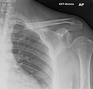 A 35-Year-Old Man with Shoulder Pain Weeks After a Car Accident ...