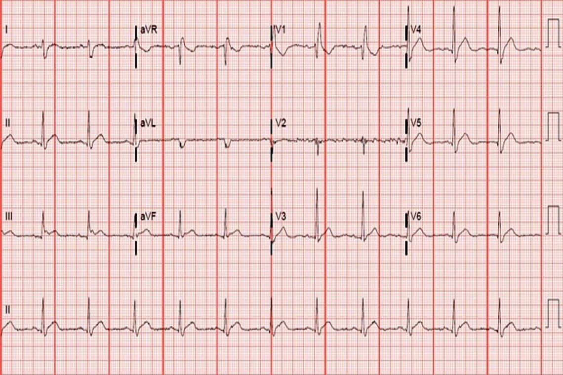 A 48-Year-Old Female with Months of Fatigue, Nausea, and Body Aches ...