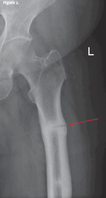 Clinical Challenges: Hip/femur x-ray Image with arrow pointing to fracture in femur