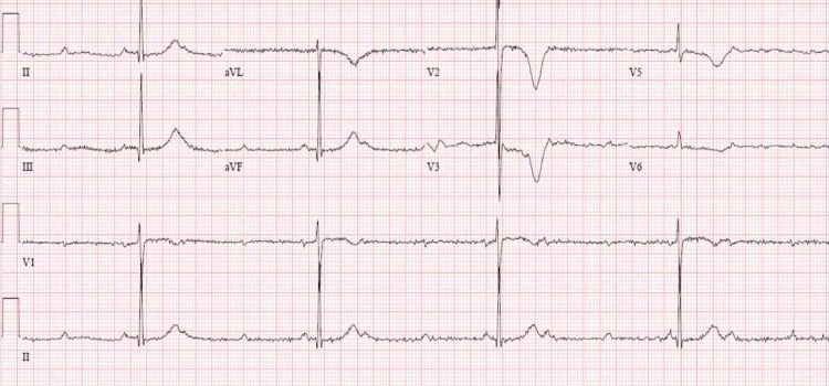 A 60-Year-Old Woman with Hypertension, Diabetes, and Sudden Fatigue and Weakness