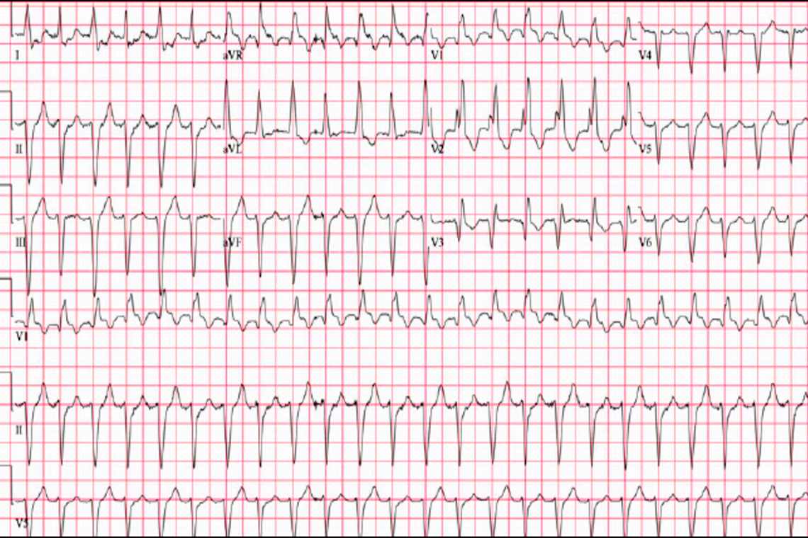 A 96-Year-Old Male with Palpitations and a History of CAD - Journal of ...