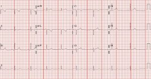 A 34-Year-Old Female with a Syncopal Episode but No Remarkable History ...