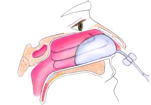 Epistaxis: A Clinical Review - Journal of Urgent Care Medicine