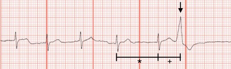 An 87-Year-Old Male with Chest Pain, SOB, and a History of Valvular ...