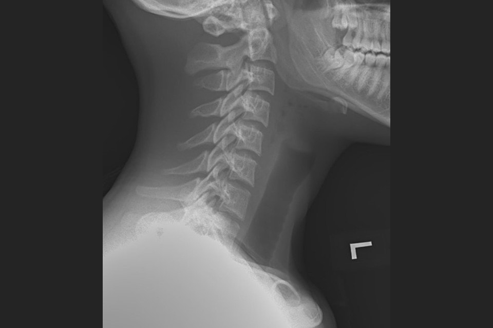 A 16 Year Old Female With Neck Pain After Swallowing Journal Of 