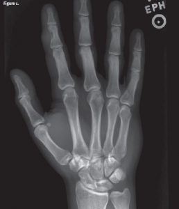 A 35-Year-Old Male with a Soft Tissue Mass on His Finger - Journal of ...