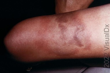 42-Year-Old With Stinging Sensation