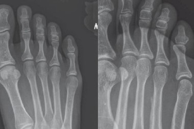48-Year-Old With Foot Pain After Hiking