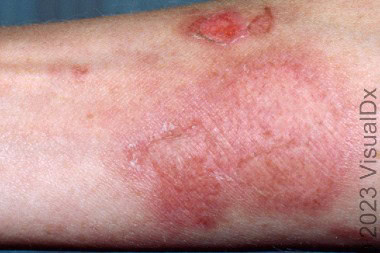 29-Year-Old With Stinging Sensation
