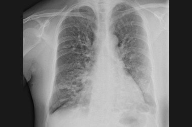 60-Year-Old With Annoying Cough