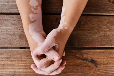 Panel Recommends Treatments for Pediatric Vitiligo