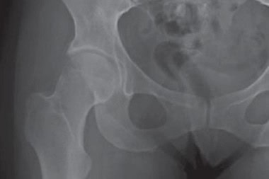 29-Year-Old With Chronic Hip Pain