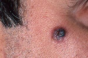 Pigmented Basal Cell Carcinoma