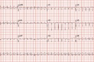 52-Year-Old With Palpitations