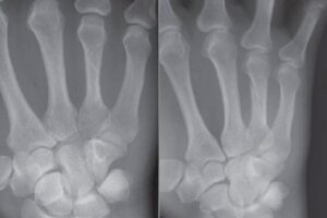 4th metacarpal shaft fracture