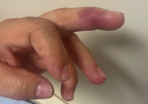 Achenbach Syndrome, Finger with Discoloration, Pain and Swelling