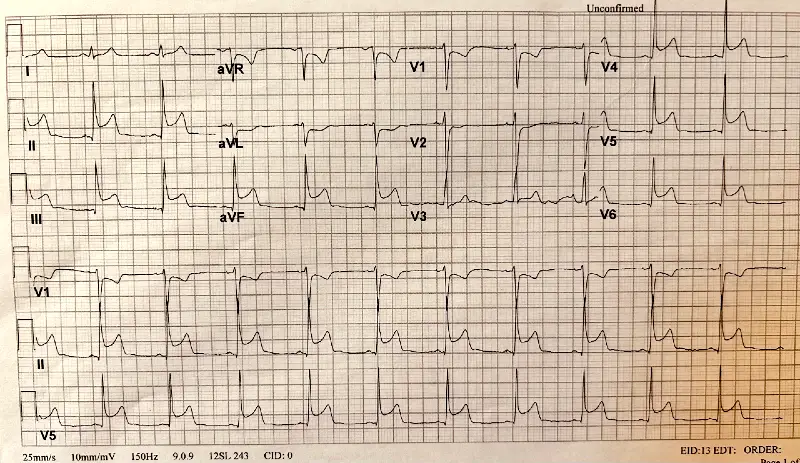 Spontaneous Coronary Artery Dissection