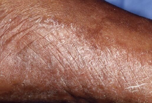 38-Year-Old With Foot Rash