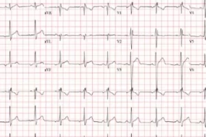 History Of Orchiopexy, Incomplete right bundle branch block (iRBBB)