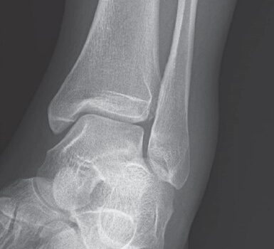 30-Year-Old With Foot Inversion Injury