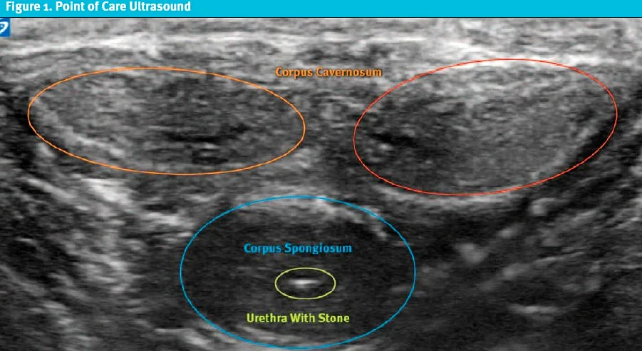 Urinary Retention Caused by a Urethral Stone 