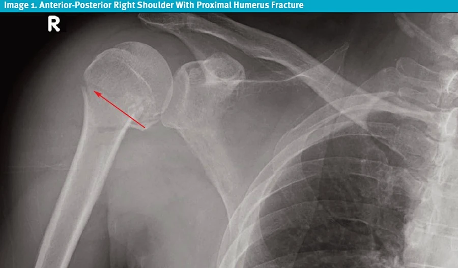 Anterior-Posterior Right Shoulder With Proximal Humerus Fracture X-ray