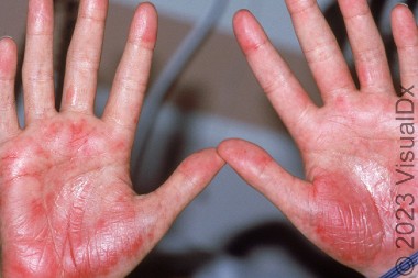 25-Year-Old With Hand Rash