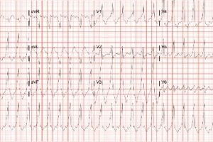 Antidromic Atrioventricular Reentrant Tachycardia