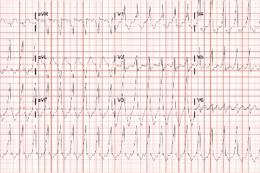 59-Year-Old With History Of Hypertension